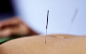 holistic healing with abdominal acupuncture in Madison, WI